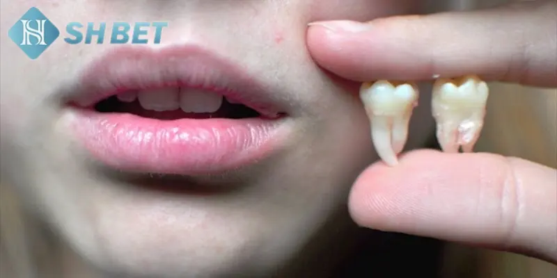 Tổng hợp chiêm bao nhổ răng và các trường hợp thường gặp nhất